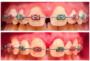 before and after gingivectomy