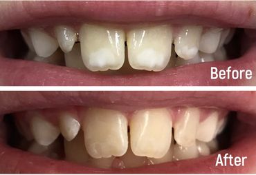 before and after of white spot treatment on teeth