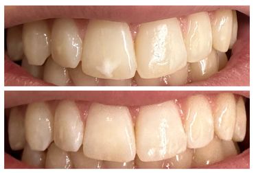 before and after of white spot treatment on teeth