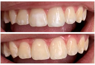 before and after of white spot treatment on teeth