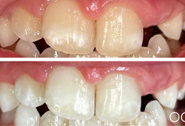 before and after of white spot treatment on teeth
