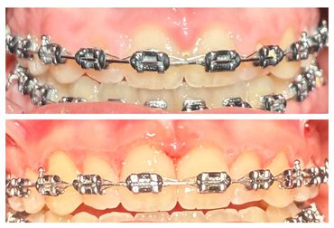 before and after gingivectomy