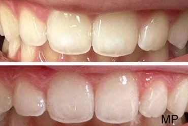 before and after of white spot treatment on teeth
