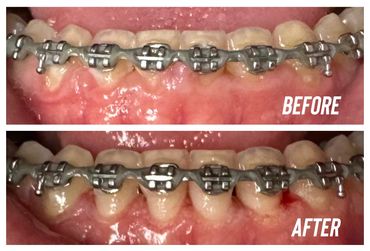 before and after gingivectomy