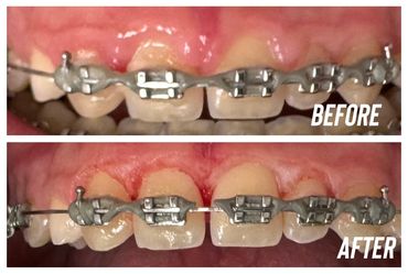 before and after gingivectomy