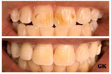 Before and after of white spot treatment on teeth