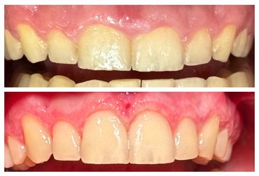 before and after gingivectomy