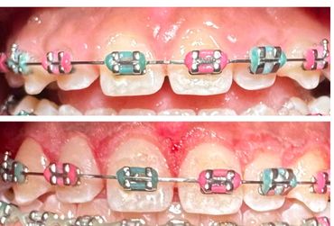 before and after gingivectomy