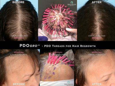 PDOgro PDO polydioxanone Threads for Hair Regrowth. Before and after results.