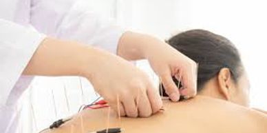 Electric Acupuncture