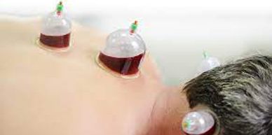Hijama (Wet Cupping)
