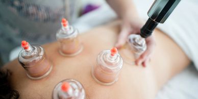 Cupping Therapy