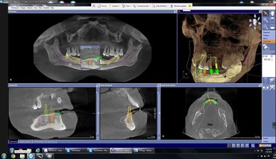 Implant planing and surgical guaid 