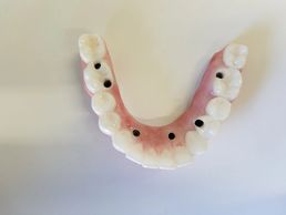 All on 6 full arch Zirconia
