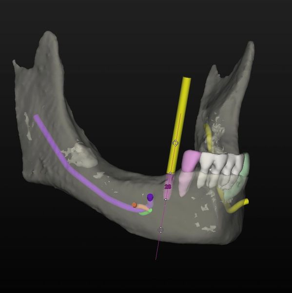 Computerized model of a lower jaw