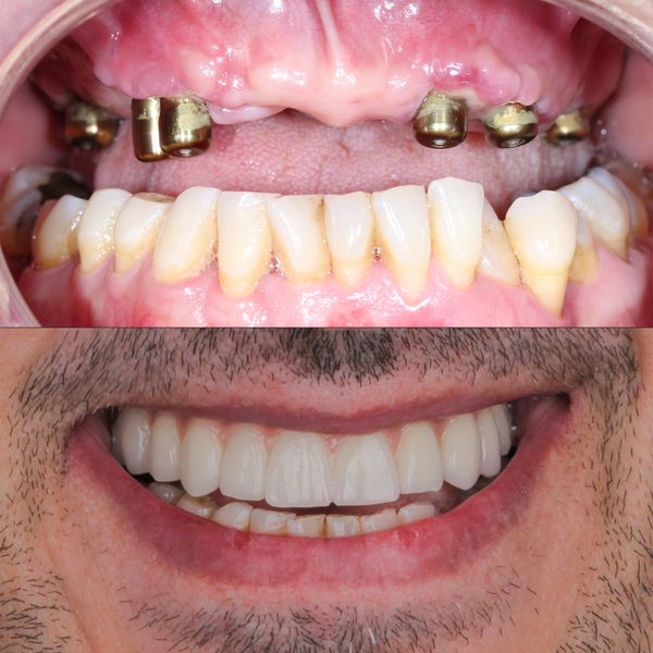 fixed teeth, all on 4, all on 6, all on 8, bad teeth, implante dentario, dental implant London.