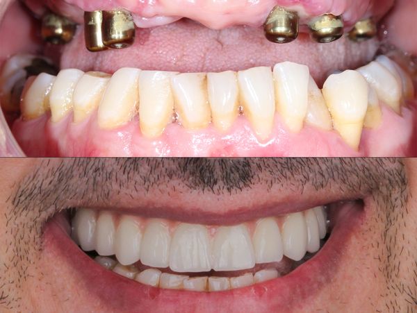 all-on-4
all-on-6
dental implant 
fixed bridge
dentures 
fixed dentures