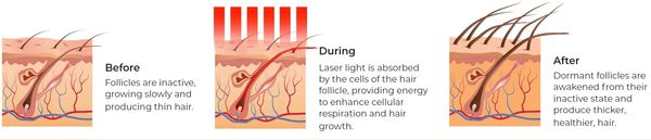 Laser Cap Therapy FDA cleared hair growth device. Dr. Joshua Pal