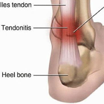 Achilles Tendon Image