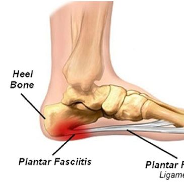 Planter Fasciitis Image