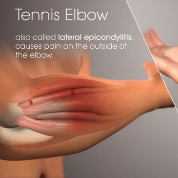 Tennis and Golfer's elbow image