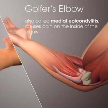 Tennis and Golfer's elbow Image