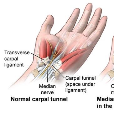 Carpal Tunnel Image