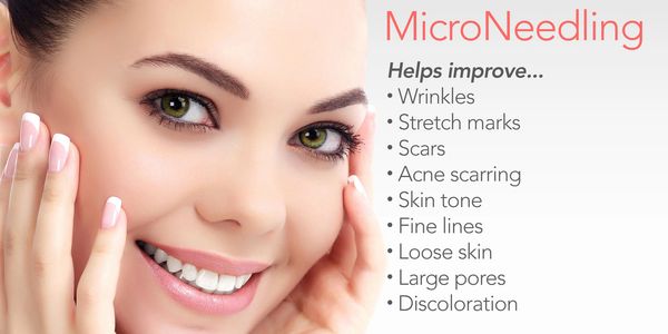 miconeedling for scars, microneedling for acne, acne before and after, stretch marks, wrinkles