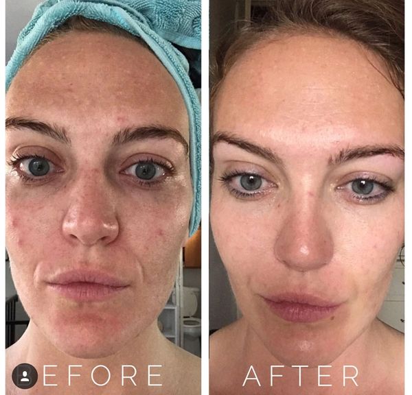 microneedling before and after, acne scarring, skin tone, fine lines, loose skin, large pores
