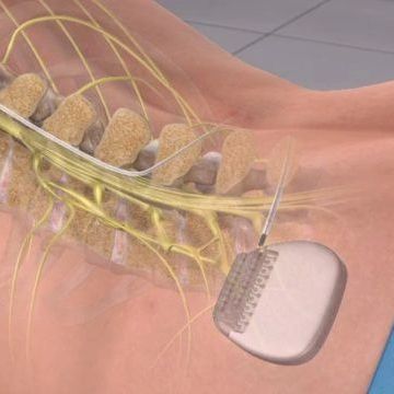 Spinal Cord Stimulator in back