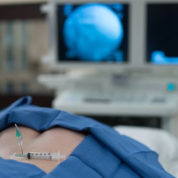 Epidural needle in back