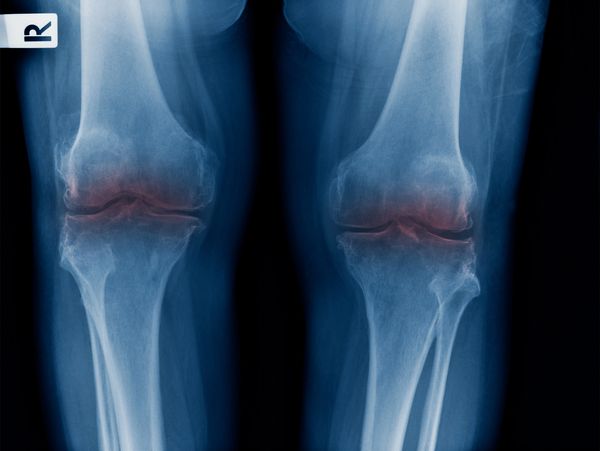 X-rays of the knees