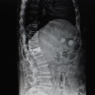 X-ray of compression fracture