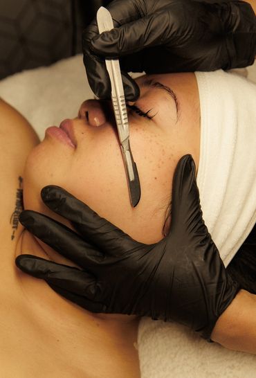 Dermaplaning is a cosmetic procedure that exfoliates the skin using a sterile blade.
It removes dead