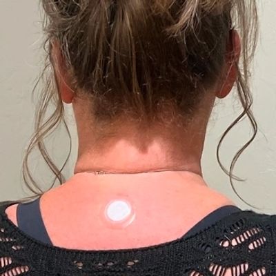 Person with messy bun hairstyle and a round patch on the back of their neck.