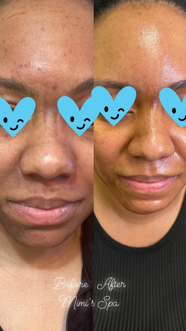 Hyper pigmentation treatment in Atlanta