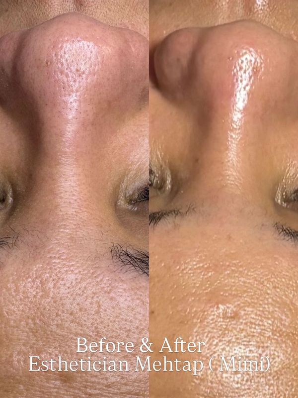 Clean skin Atlanta