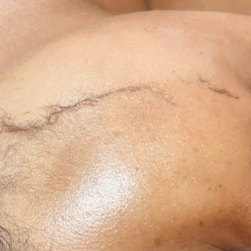 Close-up of a healed scar on skin with natural texture and hair.