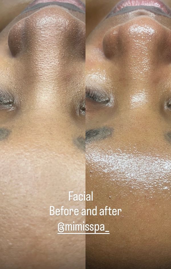 Blackhead removal in Atlanta
