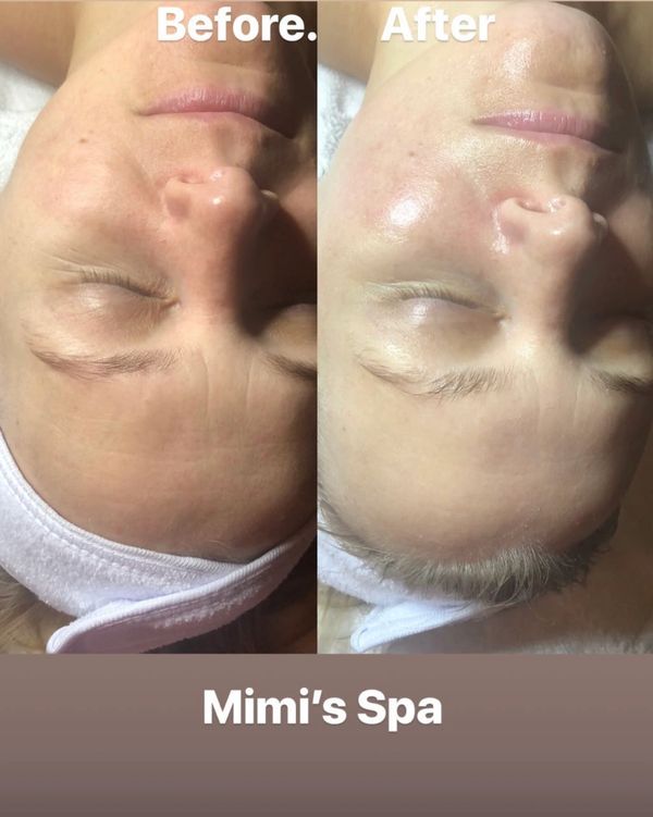 Oxygen facial in Atlanta