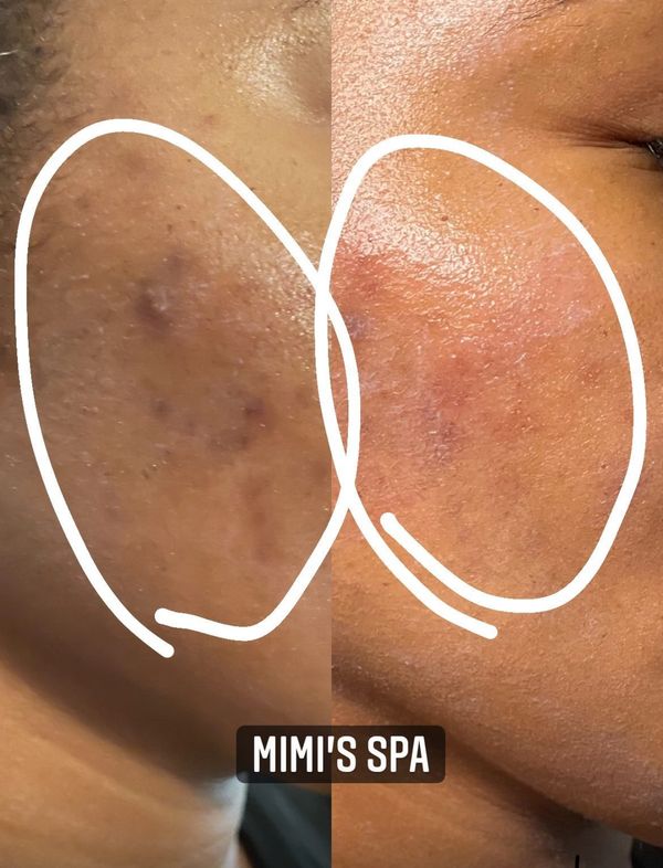 Hyper pigmentation facial in Atlanta