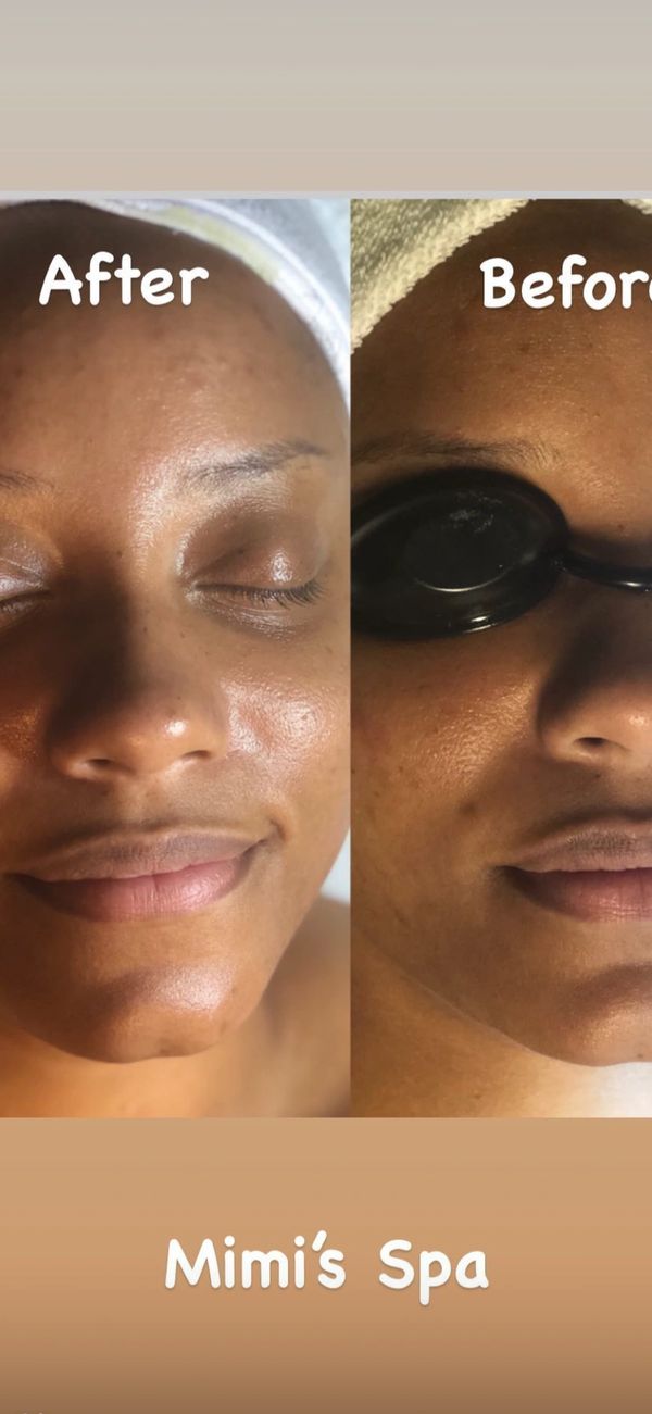 Chemical Peel in Brookhaven, Atlanta
