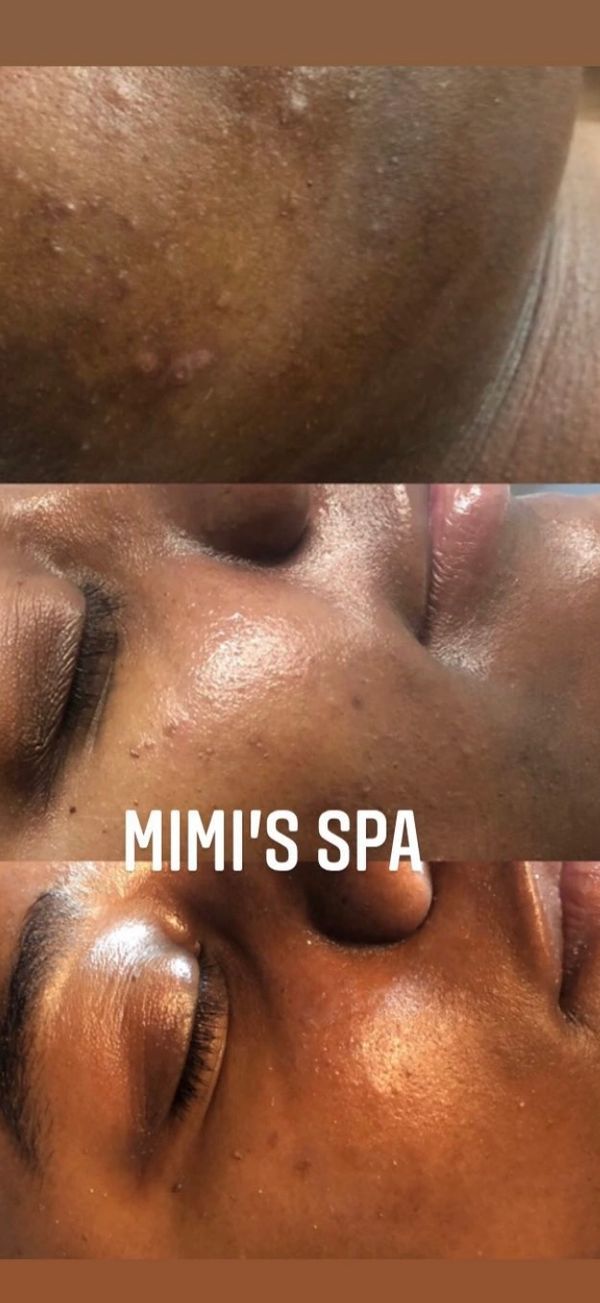 Dark skin facial in Brookhaven