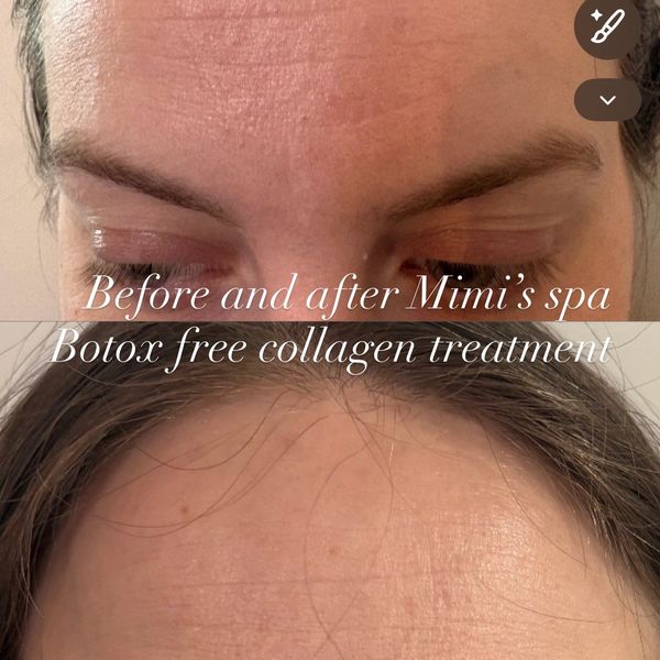 Plasma at Mimi’s Spa