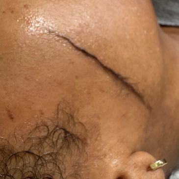 “ peach fuzz removal Mimi’s Spa”