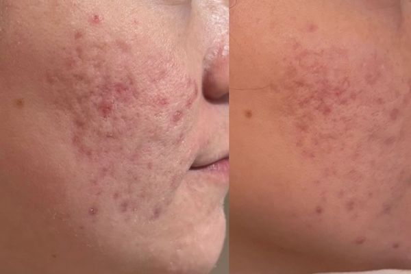 Acne scar in Atlanta