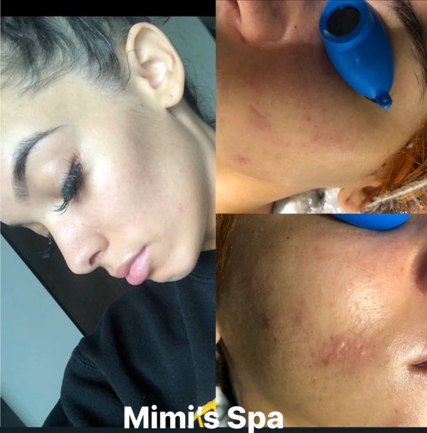 Sensitive skin facial in Atlanta