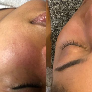 “Dark spot treatment Brookhaven “