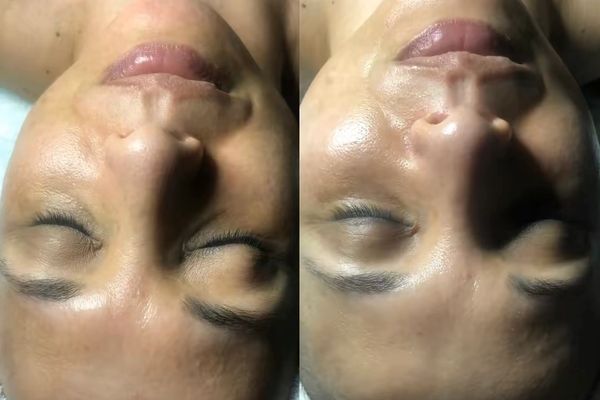 Brighting facial in Atlanta