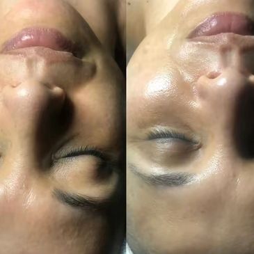 Side-by-side face comparison showing skin texture improvement.
